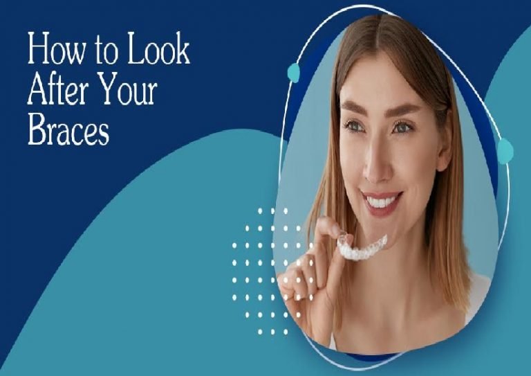 How to Look After Your Braces