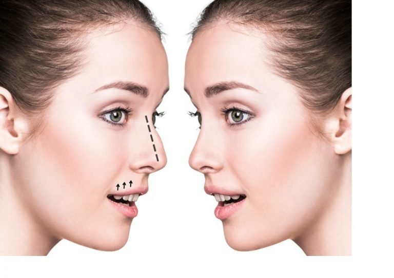 Rhinoplasty Types and Techniques