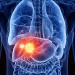 Liver Cancer