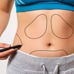 Tummy Tuck