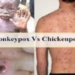 Monkeypox and chicken pox